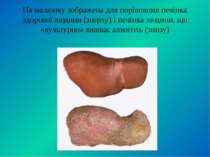 На малюнку зображена для порівняння печінка здорової людини (зверху) і печінк...