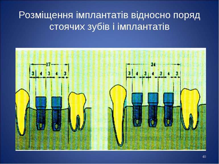 * Розміщення імплантатів відносно поряд стоячих зубів і імплантатів