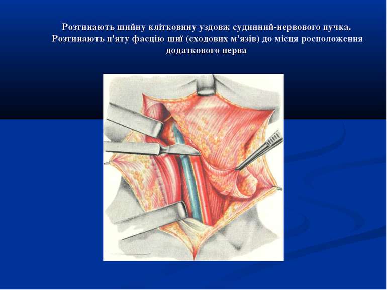 Розтинають шийну клітковину уздовж судинний-нервового пучка. Розтинають п'яту...