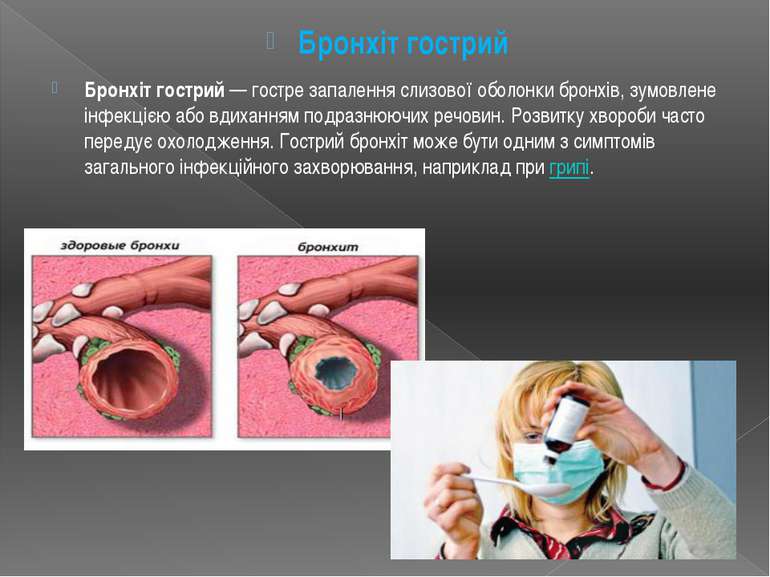 Бронхіт гострий Бронхіт гострий — гостре запалення слизової оболонки бронхів,...