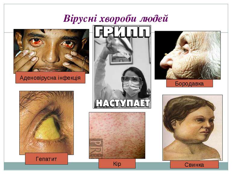 Вірусні хвороби людей Кір Бородавка Гепатит Аденовірусна інфекція Свинка