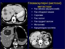Гіповаскулярні (кистозні) метастази Рак яйника (муцинозний) Рак ободової кишк...
