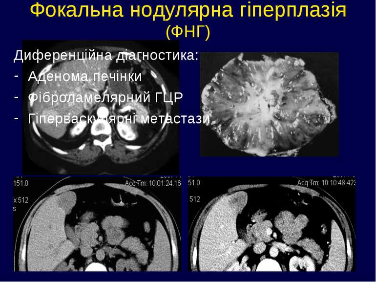 Фокальна нодулярна гіперплазія (ФНГ) Диференційна діагностика: Аденома печінк...