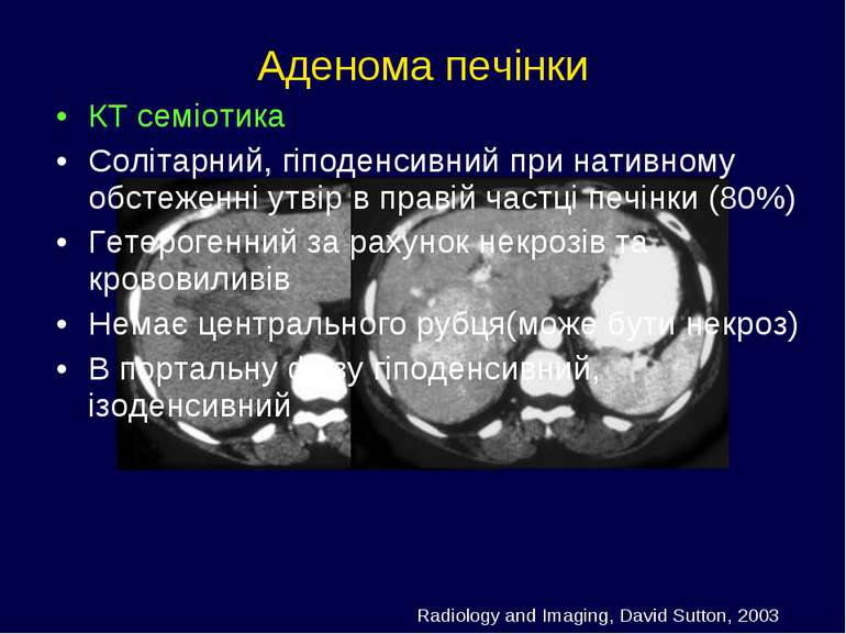 Аденома печінки КТ семіотика Солітарний, гіподенсивний при нативному обстежен...