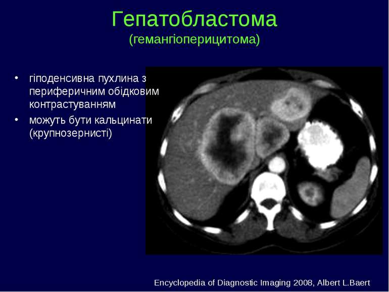 Гепатобластома (гемангіоперицитома) гіподенсивна пухлина з периферичним обідк...