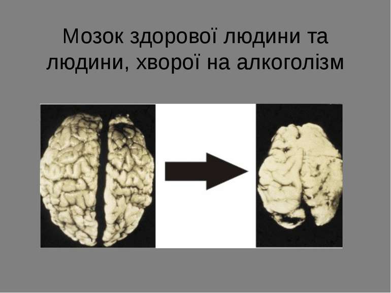 Мозок здорової людини та людини, хворої на алкоголізм