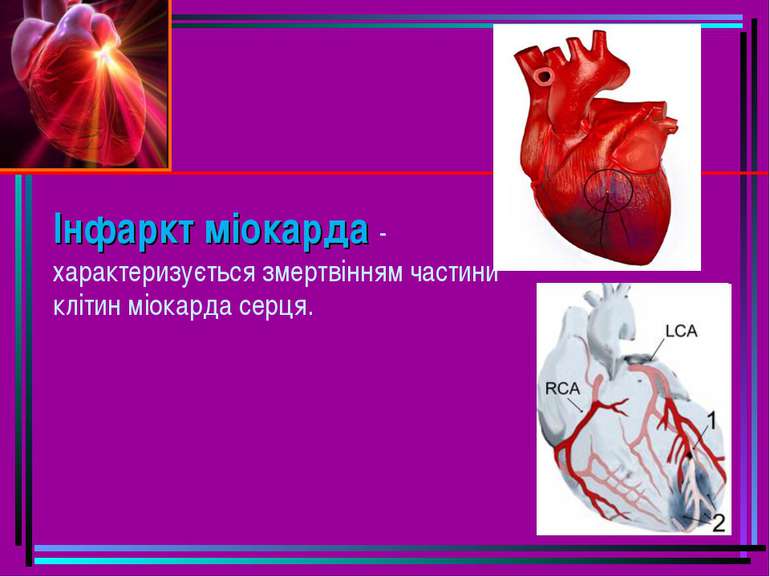 Інфаркт міокарда - характеризується змертвінням частини клітин міокарда серця.