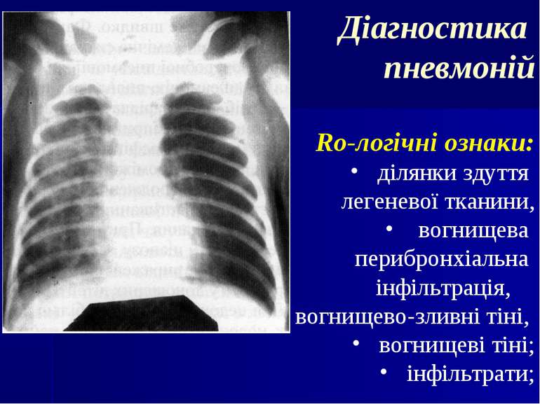 Діагностика пневмоній Ro-логічні ознаки: ділянки здуття легеневої тканини, во...