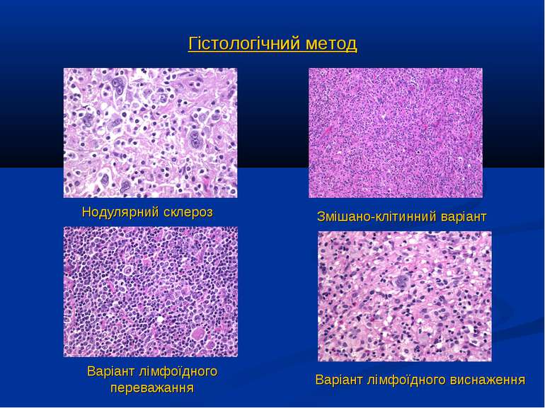 Гістологічний метод Нодулярний склероз Змішано-клітинний варіант Варіант лімф...