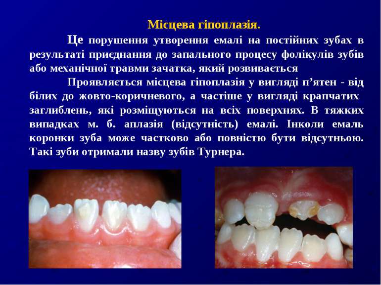 Місцева гіпоплазія. Це порушення утворення емалі на постійних зубах в результ...