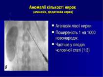 Аномалії кількості нирок (агенезія, додаткова нирка) Агенезія лівої нирки Пош...