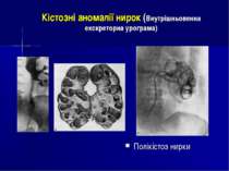 Кістозні аномалії нирок (Внутрішньовенна екскреторна урограма) Полікістоз нирки