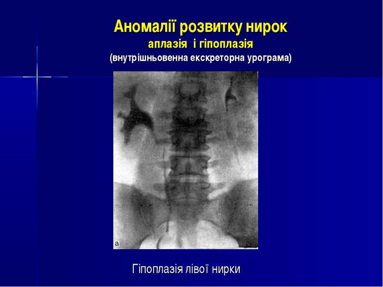 Аномалії розвитку нирок аплазія і гіпоплазія (внутрішньовенна екскреторна уро...