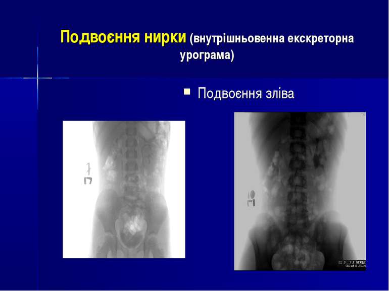 Подвоєння нирки (внутрішньовенна екскреторна урограма) Подвоєння зліва