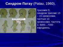 Синдром Патау (Patau, 1960), трисомія D, синдром трисомії 13 – 15 хромосоми, ...
