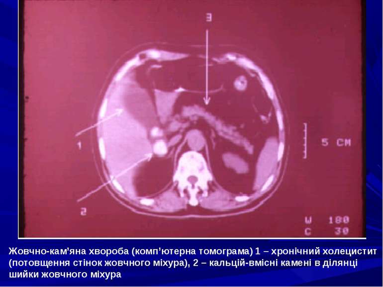 Жовчно-кам’яна хвороба (комп’ютерна томограма) 1 – хронічний холецистит (пото...