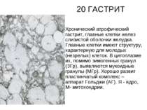 20 ГАСТРИТ Хронический атрофический гастрит, главные клетки желез слизистой о...