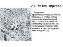 28.Клетка Вирхова : Лепрозная гранулема,лепрозная клетка Вирхова. В клетке ви...