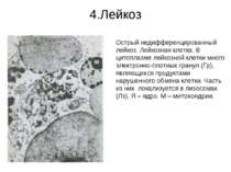 4.Лейкоз Острый недифференцированный лейкоз. Лейкозная клетка. В цитоплазме л...