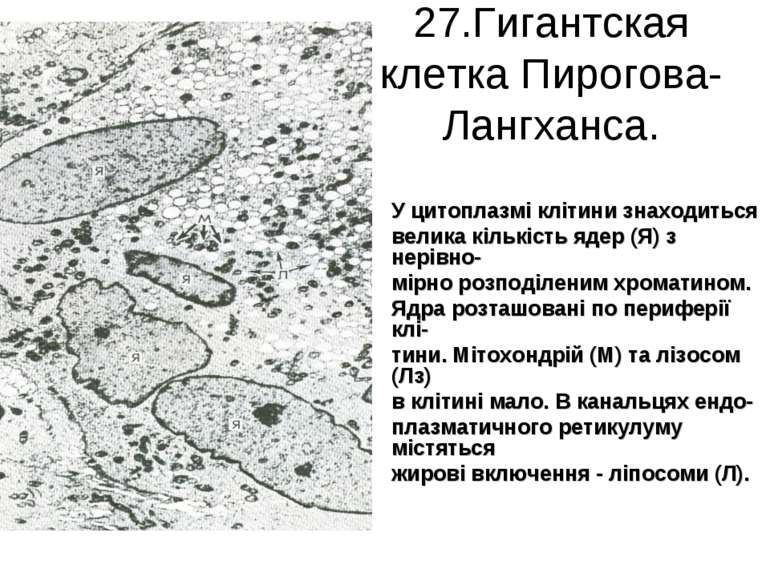 27.Гигантская клетка Пирогова-Лангханса. У цитоплазмі клітини знаходиться вел...
