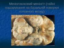 Менінгококовий менінгіт (гнійні нашарування на базальній поверхні головного м...