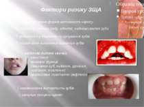Фактори ризику ЗЩА декомпенсована форма активності карієсу дефекти зубного ря...