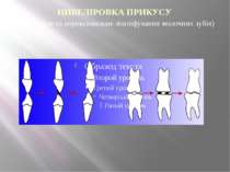 НИВЕЛІРОВКА ПРИКУСУ (оклюзійне та апроксимальне зішліфування молочних зубів)