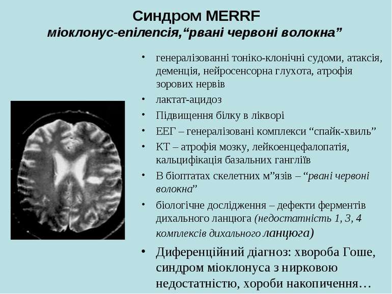 Синдром MERRF міоклонус-епілепсія,“рвані червоні волокна” генералізованні тон...