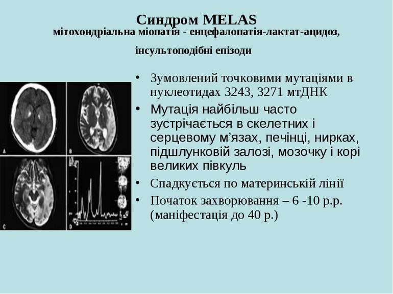 Синдром MELAS мітохондріальна міопатія - енцефалопатія-лактат-ацидоз, інсульт...