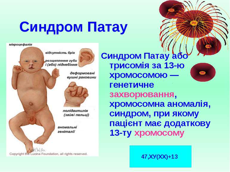 Синдром Патау Синдром Патау або трисомія за 13-ю хромосомою — генетичне захво...