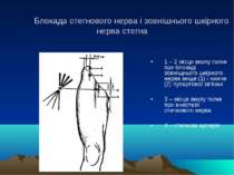 Блокада стегнового нерва і зовнішнього шкірного нерва стегна 1 – 2 місця вкол...