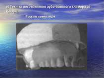 е) Техніка виготовлення зубо-ясенного кламера за Кемені. Воскова композиція.