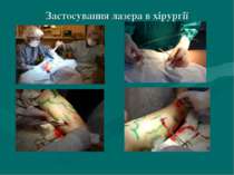 Застосування лазера в хірургії
