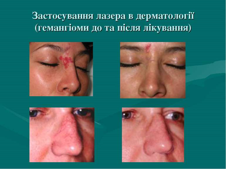 Застосування лазера в дерматології (гемангіоми до та після лікування)