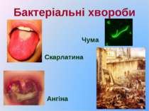 Бактеріальні хвороби Скарлатина Ангіна Чума