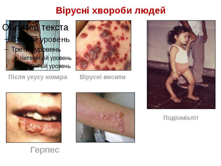 Вірусні хвороби людей Після укусу комара Вірусні висипи Подіомієліт Герпес