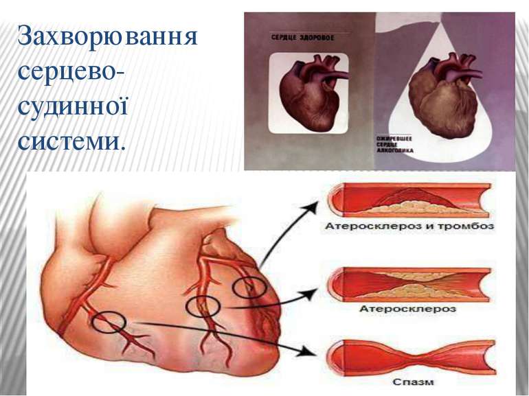 Захворювання серцево-судинної системи.
