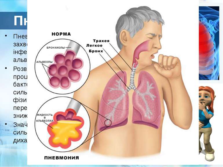 Пневмонія Пневмонія – це запальне захворювання легких, переважно інфекційної ...