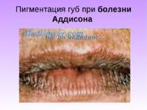 Пигментация губ при болезни Аддисона