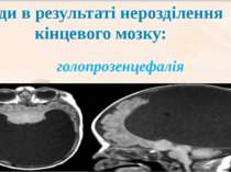        голопрозенцефалія – гемісфери не розділені на півкулі, мозкові шлуночк...