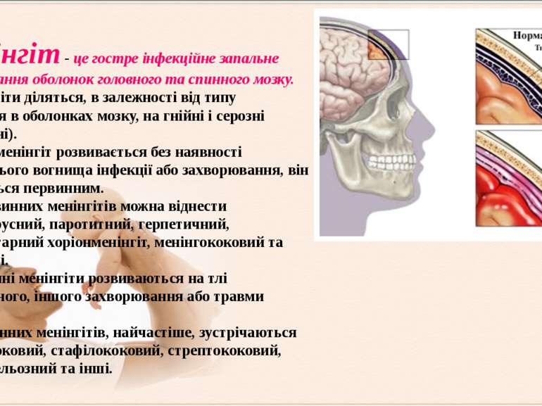 Менінгіт - це гостре інфекційне запальне захворювання оболонок головного та с...