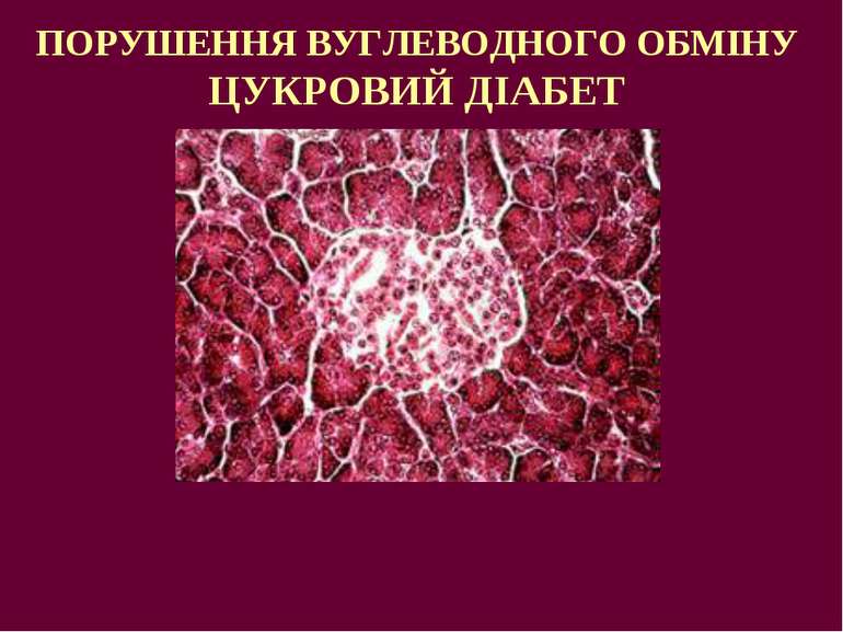 ПОРУШЕННЯ ВУГЛЕВОДНОГО ОБМІНУ ЦУКРОВИЙ ДІАБЕТ