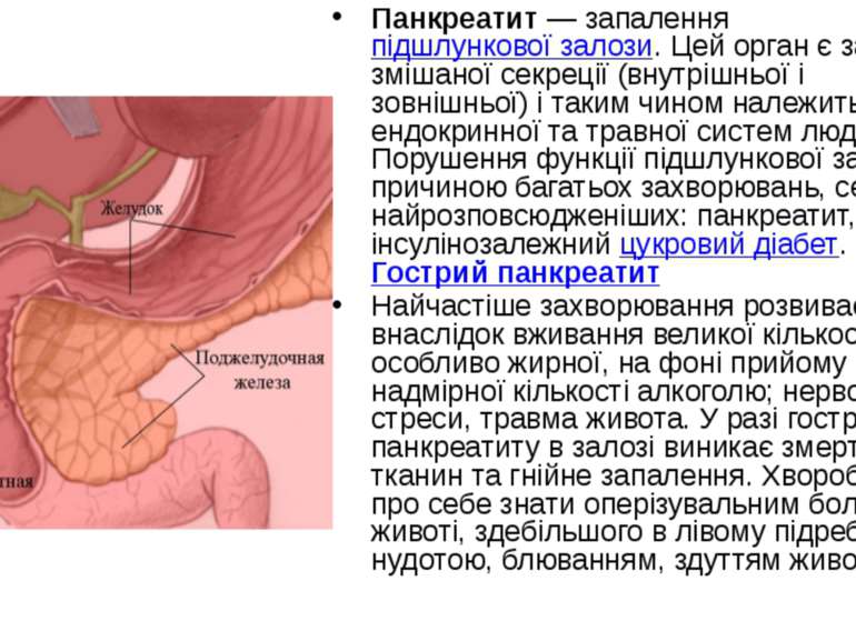 Панкреатит — запалення підшлункової залози. Цей орган є залозою змішаної секр...