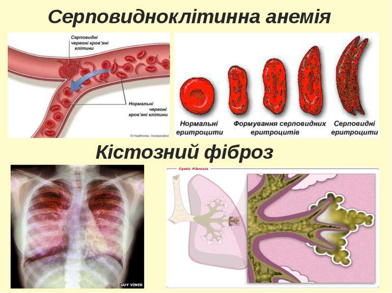 Серповидноклітинна анемія Кістозний фіброз