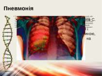 Пневмонія Пневмонія-запалення легенів. Це інфекційне захворювання легень, що ...
