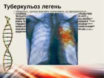 Туберкульоз легень У кожному ураженому місці виникають порушення кровообігу і...