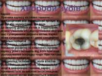 Хвороби зубів Карієс Причина карієсу кісткової тканини — дистрофічний або інф...