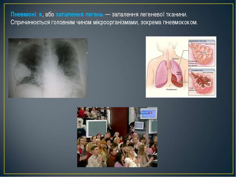 Пневмоні я, або запалення легень — запалення легеневої тканини. Спричинюється...