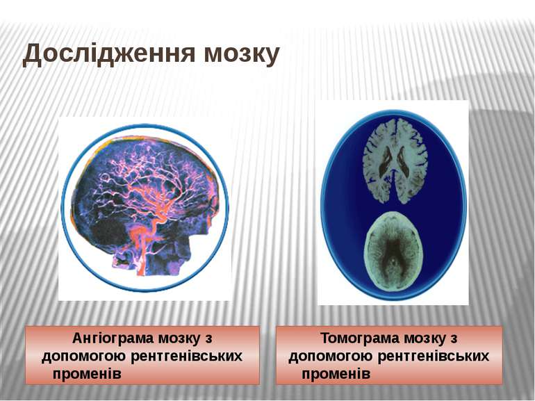 Дослідження мозку Ангіограма мозку з допомогою рентгенівських променів Томогр...
