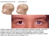Найбільш характерними є ураження органу зору (катаракта, глаукома, помутніння...
